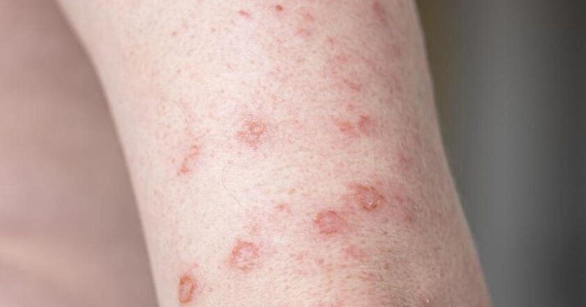 Sifiliz belirtileri nelerdir? Sifiliz nasıl anlanır? Tedavi yöntemleri nelerdir?